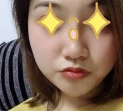 上海伊美爾港華醫(yī)院磨骨真人案例果圖流出：對比挺明X