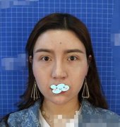 北京沃爾馮雁平鼻部手術(shù)案例果圖分享&術(shù)后恢復(fù)記錄一覽