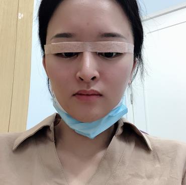 長(zhǎng)春趙廣文院長(zhǎng)眼部手術(shù)術(shù)后半年果分享：眼型較為適合我