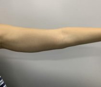 在北京協(xié)和醫(yī)院整形科做了吸脂減肥手術(shù)，果就是好