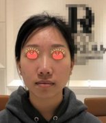 重慶華美張國(guó)強(qiáng)隆鼻怎么樣？?jī)蓚€(gè)月恢復(fù)案例自述