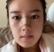 北京新星靚宮風勇鼻修復案例反饋：術后自然挺拔有型