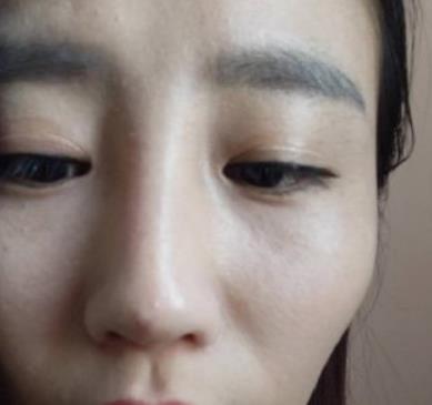 北京藝美王東醫(yī)生脂肪填充案例公開，術(shù)后太陽(yáng)穴飽滿自然