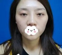 北京東方和諧馮斌脂肪面部填充案例：飽滿度還不錯(cuò)！