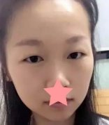 成都華西醫(yī)院整形科雙眼皮怎么樣？術(shù)后一個(gè)月果展示