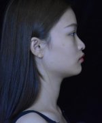 北京沃爾整形美容醫(yī)院磨骨日記術(shù)后果口碑評(píng)價(jià)，輕松成小V臉