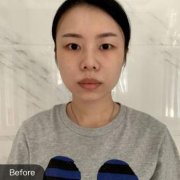 湖州曙光李祿增雙眼皮技術怎么樣？兩個月后還是挺自然的