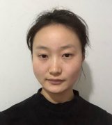 重慶時(shí)光整形美容醫(yī)院削骨術(shù)后經(jīng)驗(yàn)+果對(duì)比圖分享