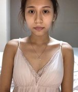 重慶一附院整形科真人隆胸案例，自然恢復(fù)過(guò)程圖分享