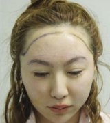 廣東省人民醫(yī)院可以植發(fā)嗎？發(fā)際線種植案例展示，術(shù)后年輕了好幾歲！