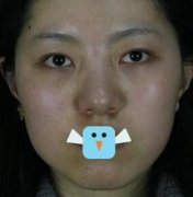 臺州藝星耳軟骨隆鼻果怎么樣？請參考李星星真人隆鼻案例