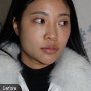 包頭市中心醫(yī)院半肋骨鼻部手術(shù)6個(gè)月果圖,整形風(fēng)格技術(shù)解析