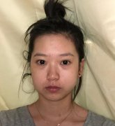 贛州儷人整形醫(yī)院面部吸脂果確實好，臉上的嘟嘟肉不見了