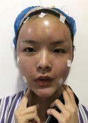 鄭州惠美整形醫(yī)院面部脂肪填充日記一覽：讓我重拾少女臉