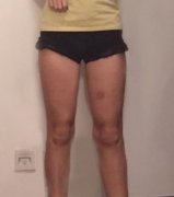 去成都華西醫(yī)院整形科做了大腿吸脂手術(shù)，夏天終于敢露腿了！