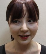 邯鄲市第四醫(yī)院整形科自體脂肪填充面部日記展示，飽滿自然敲可愛(ài)