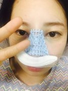 長沙美萊整形醫(yī)院潘衛(wèi)峰院長做的隆鼻果公開，手術(shù)日記經(jīng)驗分享