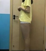 山東省立醫(yī)院整形科高峰大腿吸脂如何？案例對比證實醫(yī)生技術(shù)！