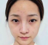 上海九院李青峰做鼻子怎么樣預(yù)約？案例手術(shù)風(fēng)格盡顯！