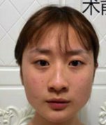 上海仁愛醫(yī)院整形科磨骨怎么樣？下頜角案例全新來(lái)襲，可參考！