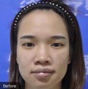 長沙美萊玻尿酸豐下巴術(shù)后2個月果照，注射技術(shù)真的很好