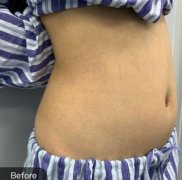 濟(jì)寧壹美腰腹吸脂術(shù)后一個(gè)月照片~終于穿上了S碼的褲