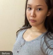 濟寧名美整形美容醫(yī)院自體脂肪豐胸術后一個月，胸部真的變得很大哦