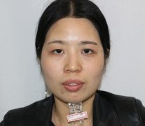 南寧?kù)诿勒吾t(yī)院雙眼皮案例曝光，術(shù)后果對(duì)比圖流出