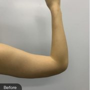 臺州市中心醫(yī)院整形美容外科胳膊吸脂塑形第30天果圖