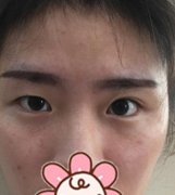 廣州南方醫(yī)院整形科馮傳波醫(yī)生雙眼皮案例來了，真實果打卡！