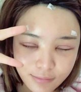 北京玉之光王明利做自體脂肪填充怎么樣?面部填充案例分享【多圖】！