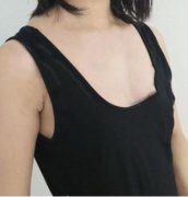 北京大學第三醫(yī)院整形科趙振民隆胸怎么樣？案例果對比實拍圖