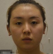 蘭州時(shí)光激光美容祛斑怎么樣？手術(shù)果（費(fèi)用）了解一下！