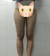 鄭大二附院整形科劉月麗抽脂怎么樣？大腿抽脂案例來查看！