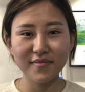 河南中醫(yī)藥大學(xué)第一附屬醫(yī)院整形科下頜角磨骨可靠嗎？看趙絳波醫(yī)生案例查實(shí)情