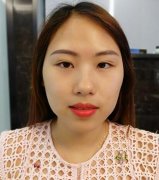 天津市第五中心醫(yī)院整形科面部提升手術(shù)怎么樣？恢復全過程+圖片分享