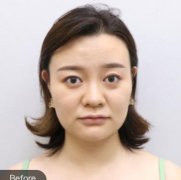 海南面部埋線提升面診哪家醫(yī)院好?省人民醫(yī)院整形科真人案例分析果