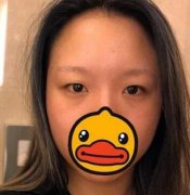 成都西區(qū)醫(yī)院整形鄧東偉雙眼皮怎么樣？術(shù)后一個(gè)月果圖可見！