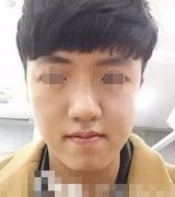 北京八大處整形醫(yī)院削骨怎么樣？手術(shù)后恢復(fù)男生也能錐子臉