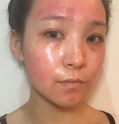 湖南省第二人民醫(yī)院整形美容科祛斑多少錢？果好嗎？