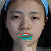 東莞康華醫(yī)院整形美容中心做雙眼皮如何？真人案例對比圖發(fā)布