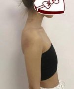 上海九院曹衛(wèi)剛抽脂隆胸怎么樣？真人案例及價格表一覽