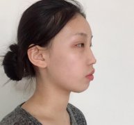 上海九院整形科做熱瑪吉怎么樣?術(shù)后案例果對(duì)比圖分享