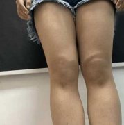 八大處王春虎怎么樣？個人簡介和吸脂手術(shù)前后全過程圖片分享