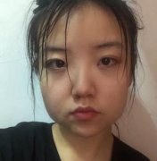 下頜角整形案例及價(jià)格表明細(xì)一覽！