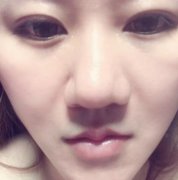 濟(jì)南華美整形醫(yī)院脂肪填充面部果圖一覽，經(jīng)驗(yàn)反饋