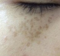 濟(jì)南華夏醫(yī)院激光美容科祛斑怎么樣？術(shù)后果圖分享