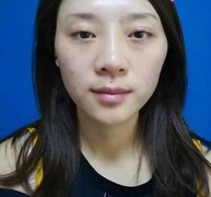 淮安市第一人民醫(yī)院整形美容科面部脂肪填充真人案例~含果對(duì)比圖