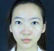 北京八大處靳小雷隆鼻果怎么樣？看真人案例可參考!