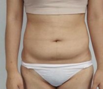 北京東方和諧馮斌醫(yī)生腰腹吸脂果如何？小腰精太好看了！